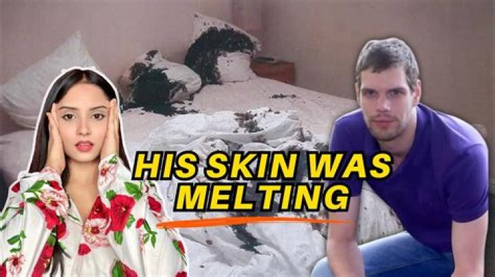 Mark Van Dongen Face Before And After Pictures: Paralysed Acid Attack Victim Committed Assisted Suicide Death